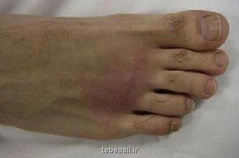 یک فوق تخصص جراحی پا مطرح کرد؛ علل انحراف انگشت شست پا، ۱۵۰ نوع روش جراحی