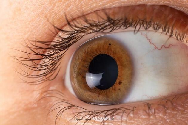 ۶ بیماری مهم که چشم ها در مورد آنها اخطار می دهند