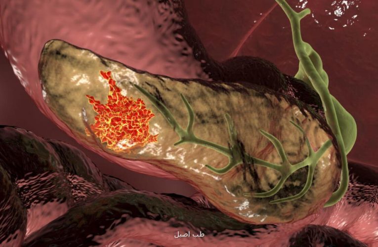 این باکتری، سرطان مرگبار لوزالمعده را درمان می کند؟