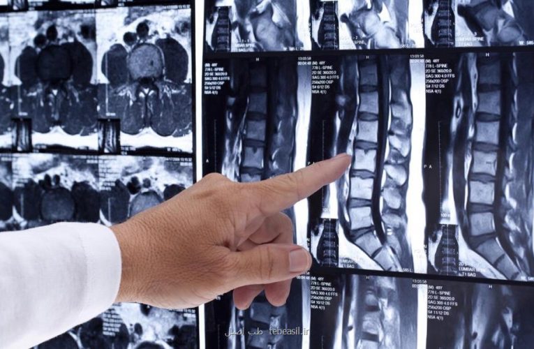 موفقیت پژوهشگران دانشگاه کمبریج در درمان ایمن صدمه های نخاعی